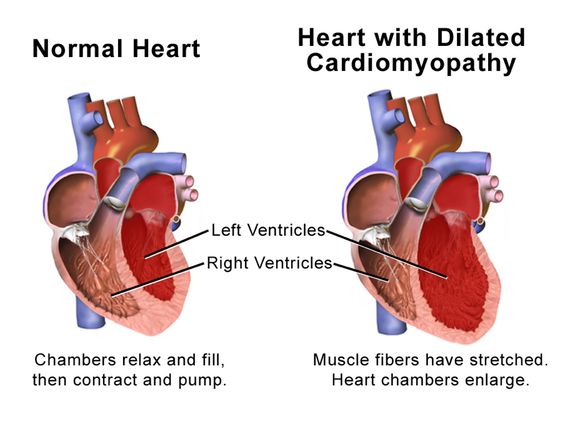 Invloed Van Alcohol Op Het Ontstaan Van Cardiomyopathie Hartfalen En 